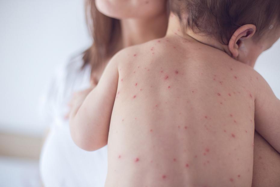 Measles-1200×800